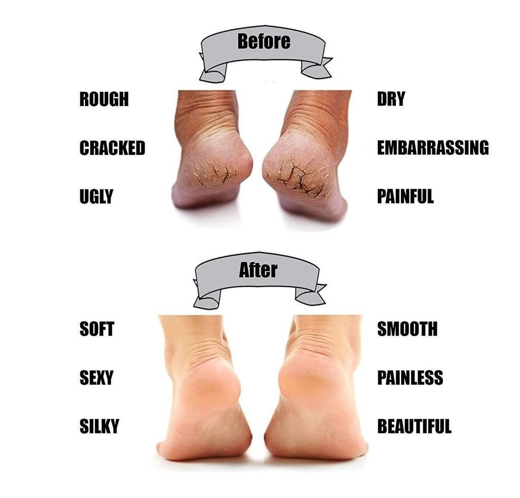 Silicone Gel Heel Protector Socks for Cracked Heels, Pain Relief & Moisturizing Support