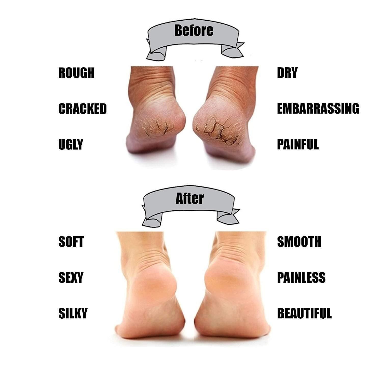 Silicone Gel Heel Protector Socks for Cracked Heels, Pain Relief & Moisturizing Support